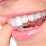 How Invisalign Aligners Enhance Airway Function Through Strategic Tooth Repositioning