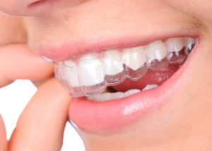 How Invisalign Aligners Enhance Airway Function Through Strategic Tooth Repositioning
